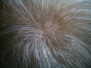 Crown area of fine density hair addition