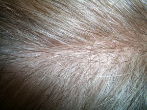 Parting area of fine density hair addition